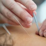 Acupuncture for Wellbeing