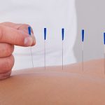 Oriental Acupuncture