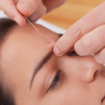 Acutherapy Acupuntura Alicante ??