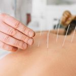 Acupuntura fisiatríca