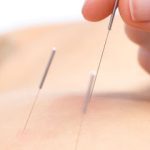Acupunctura Dr Cai